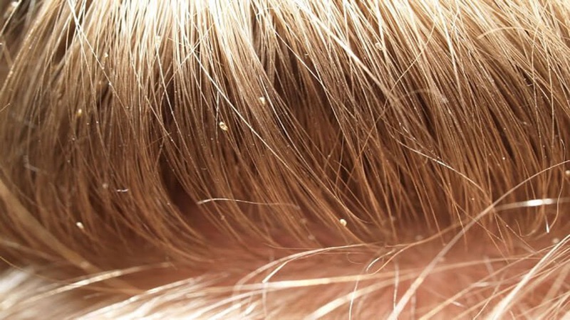 Lice eggs (nits) attached to strands of hair near the scalp